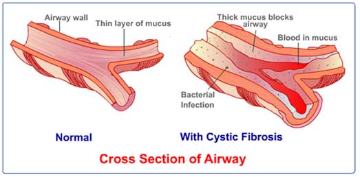 amalunawellness.com_wp-content_uploads_2015_02_cystic-fibrosis-c-s-airway.jpg
